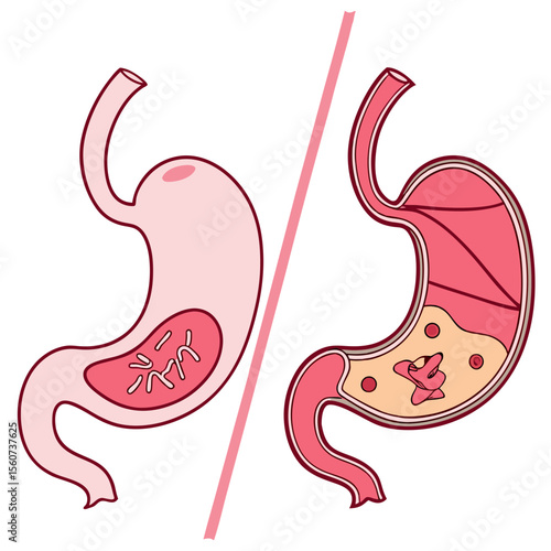Human stomach. Healthy and unhealthy, Bloating stomach ache, digestive tract pain fullness heaviness stomaches acid heartburn process