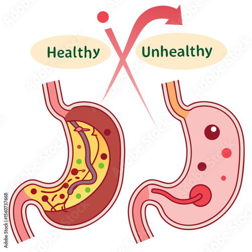 Human stomach. Healthy and unhealthy, Bloating stomach ache, digestive tract pain fullness heaviness stomaches acid heartburn process