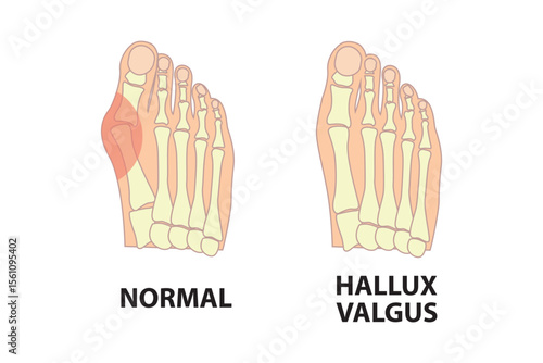 Healthy foot and foot with Bunion. Human anatomy. Skeleton