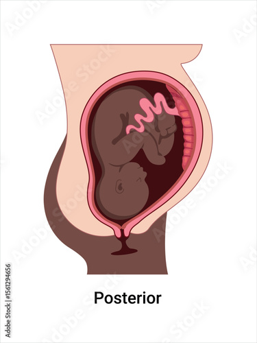Posterior baby positions in the uterus during pregnancy. Dark-skinned woman. Pathology. Detailed medical vector illustration. Fetus with umbilical cord, placenta.
