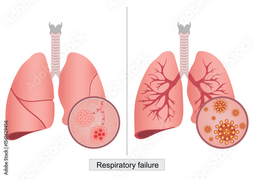 Respiratory failure happens when not enough oxygen passes from lungs to blood.