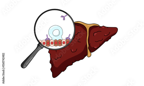Autoimmune hepatitis disease. Liver organ with inflammation, infection and virus. Inflammation in human body. Vector illustration for medical, clinic or biology study