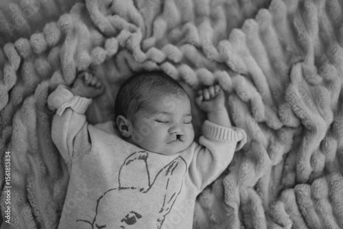 Obraz na plátně A sleeping newborn baby with congenital defect of cleft lip and palate wrapped in a cozy blanket, resting peacefully in a crib