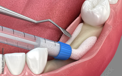 Bone grafting augmentation for tooth implantation. Medically accurate 3D illustration