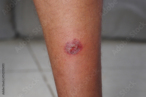 Red swollen wound on the leg with visible discharge and irritation after burn on motorcycle exhaust pipe.