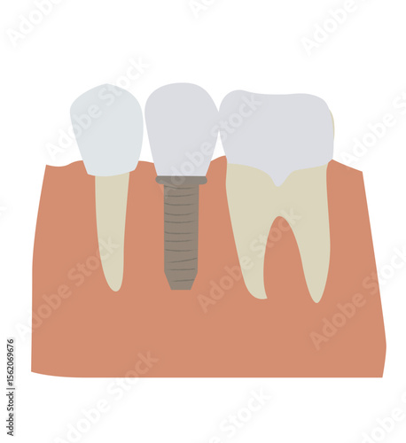  vektor tooth implantation, tooth restoration, Mesh gradient wes. dentures