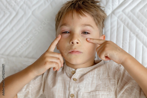 Toddler child with conjuctivitis, lying in bed with red eyes, inflamation of eye disease, cured with eye drops