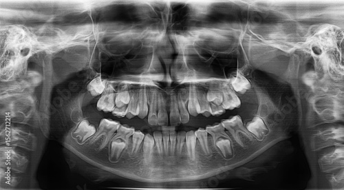 Radiography of a child's teeth