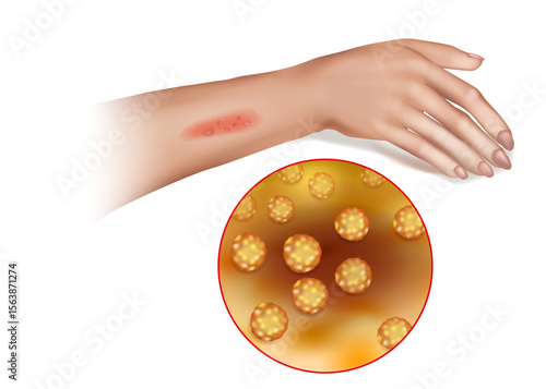 Staphylococcus Aureus Skin Infection with Close-Up Bacteria View. Bacterial Skin Lesion Caused by Staphylococcus Aureus on Human Arm