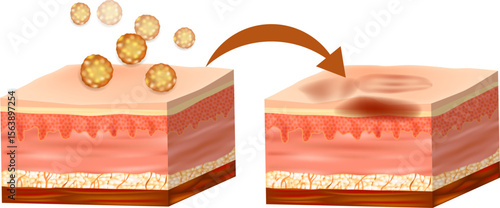 Medical Diagram of Infection Progression in Human Skin Tissue. Bacterial Penetration and Inflammatory Response in Skin Layers. Skin Infection Development Process