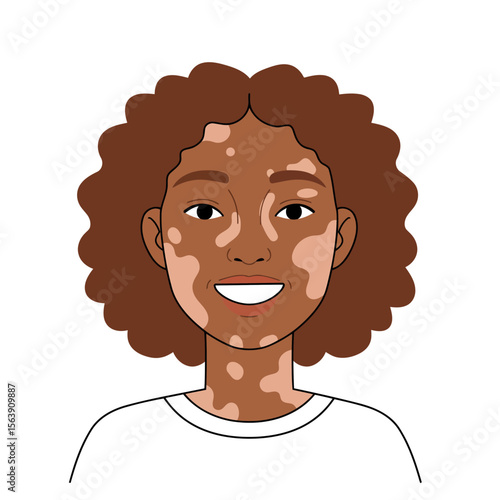 Embracing Uniqueness: A Portrait of a Beautiful Person with vitiligo smiling and radiating confidence and inner beauty, celebrating diversity and self-acceptance.