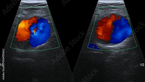 Ultrasound scan of a patient's abdominal aorta aneurysm
