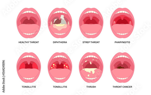 Oropharyngeal infections poster