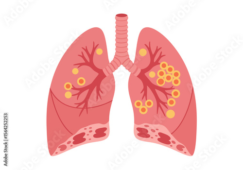 Diseased Lungs Illustration with Tumors and Damaged Tissue Medical Concept.