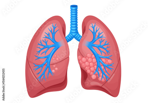 Detailed Illustration of Human Lungs with Bronchial Tree and Alveoli.