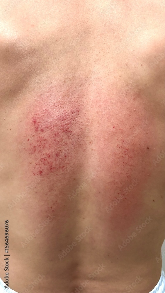 Fototapeta premium close up of red Bruise on a woman skin.