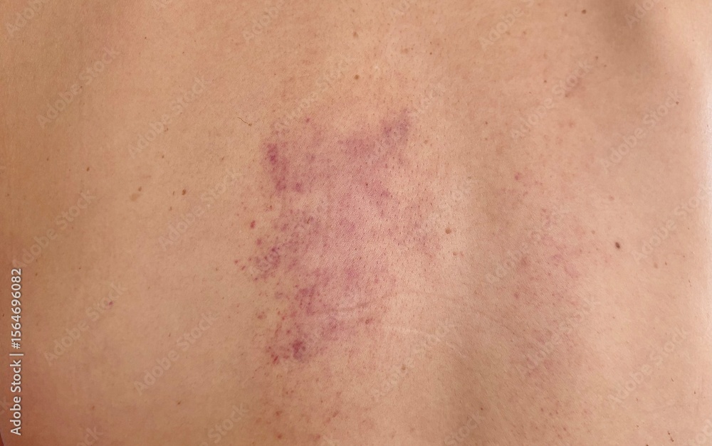 Fototapeta premium Close up red Bruise on the skin.