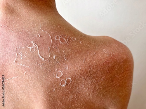 Detailed view of dry, peeling skin on a sunburned shoulder after excessive sun exposure