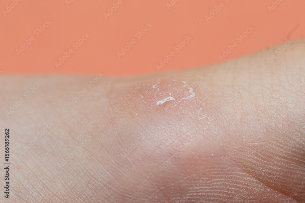 Fototapeta premium Damaged skin showing signs of healing after burn on orange background