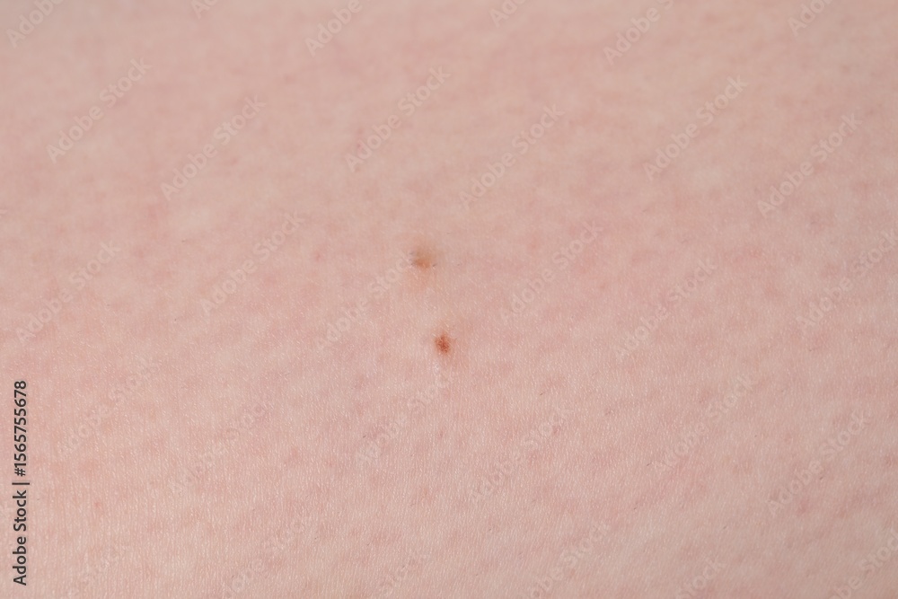 Fototapeta premium Woman with moles on her body, closeup