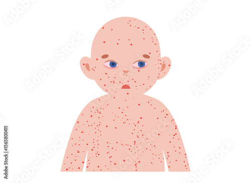 The most common viral rashes