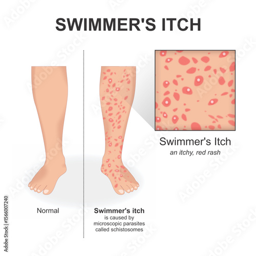 Swimmer's itch by microscopaic parasites called schistosomes