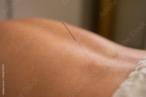 A person is getting a needle stuck into their back. The needle is thin and silver. The person is laying on a table