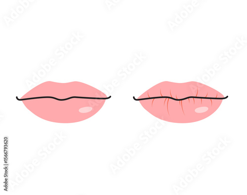 Cartoon medical drawing showing a healthy mouth and a dry cracked lips that needs hydration vector illustration