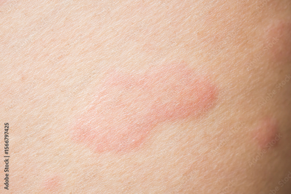 Fototapeta premium Skin allergy rash dermatitis texture close up background