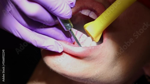Dental Cleaning Procedure With Ultrasonic Scaler , Close-up video of a dental hygienist using an ultrasonic scaler to clean a patient's teeth during a routine dental check-up.  