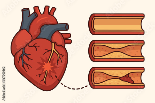 Heart Attack Pathology and Atherosclerosis Progression Vector. Coronary Artery Disease, Blocked Arteries, Myocardial Infarction, Plaque Build Up, Cardiovascular Health, Medical Cartoon Illustration