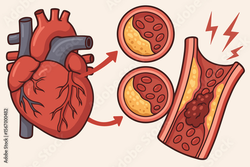 Vector illustration of heart attack pathology, atherosclerosis progression, clogged arteries, cholesterol plaque buildup, cardiovascular disease, coronary artery blockage, medical anatomy concept
