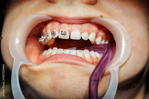Close-Up of Braces Installation on Upper Teeth,Orthodontic treatment in progress showing close-up of dental braces being applied to upper teeth with cheek retractor and suction tube.