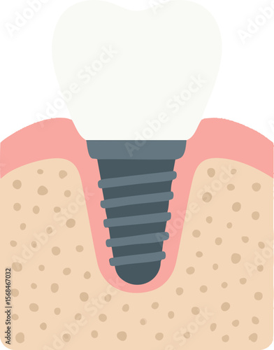 Flat vector dental implant with crown, screw and jawbone diagram, isolated on white