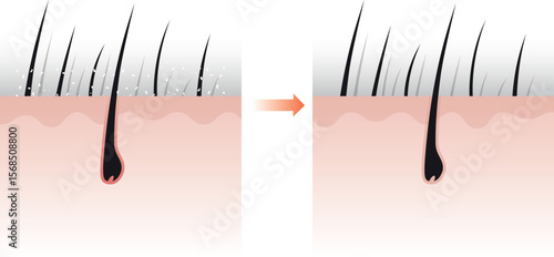 Comparison of dandruff and healthy hair in the scalp layer. Comparison of well-groomed hair and ungroomed hair.