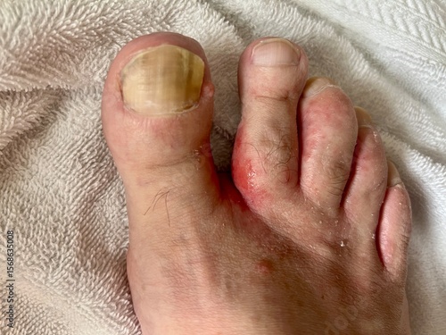 Close-up of foot showing thick, yellowed toenails with visible fungal infection and redness from secondary infection around toes