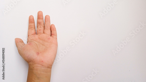 Child's hand with symptoms of  hand, foot and mouth disease or HFMD with red spots and blisters. Viral Diseases. Infectious Diseases. White background