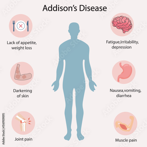 Flat vector illustration of Addison’s disease showing symptoms like fatigue, dark skin, depression, nausea, joint pain. Similar to adrenal insufficiency and hypothyroidism.