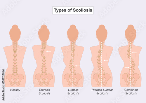 Female Scoliosis is a condition where the spine curves abnormally to the side.