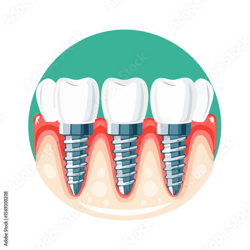 Illustration of Three Dental Implants in Gums