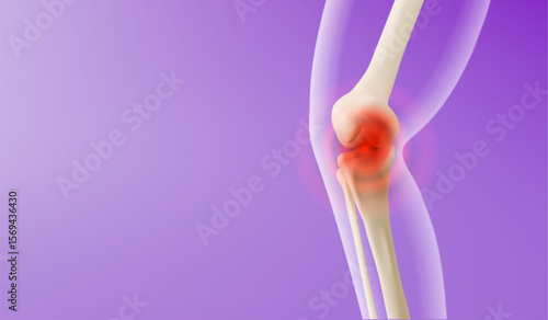 3d knee pain visualization - leg bones with red inflammation glow at joint area on purple gradient background. Medical concept showing arthritis, injury location for orthopedic diagnosis and treatment
