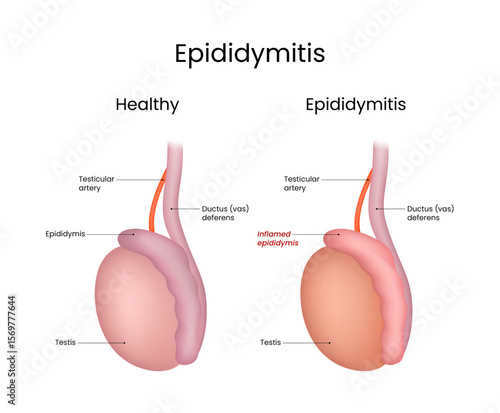 Comparison of Healthy Testicle and Testicle with Epididymitis