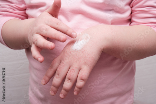 Billede på lærred a child smears his hands with cream, children's hands with atopic dermatitis in