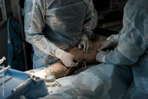 Laser catheter inside the vein beneath skin surface. EVLA in progress under sterile conditions, guided by ultrasound imaging.