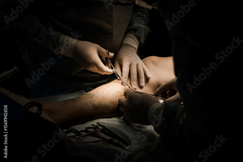 Принти на полотні Close-up of hands inserting fiber into vein during laser vein ablation