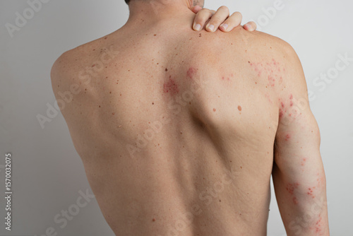 Foto Caucasian male scratching his back and shoulder suffering from chickenpox virus,