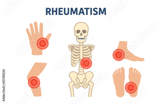 A medical set for rheumatism or rheumatic disorders, including arthritis and joint pain syndrome, is depicted with pain rings on various body parts such as the hand, leg, feet, spine, skull, and