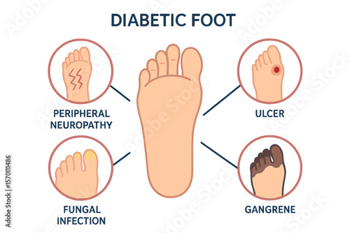 Medical vector illustration scheme of diabetic foot with common conditions