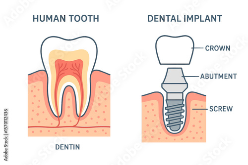 A vector illustration depicting the structure of human teeth and dental implants, including detailed components such as the crown, abutment, and screw