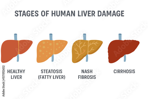 The concept of human liver damage is represented in stages, from a healthy liver to steatosis, fatty NASH, fibrosis, and cirrhosis, as a vector cartoon illustration of reversible and irreversible